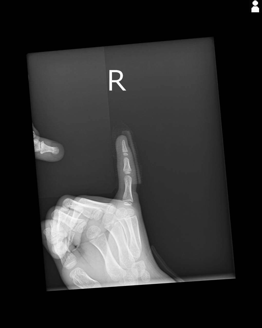 スポーツで指の怪我した学生の初回対応と施術 大鳥居にある整骨院