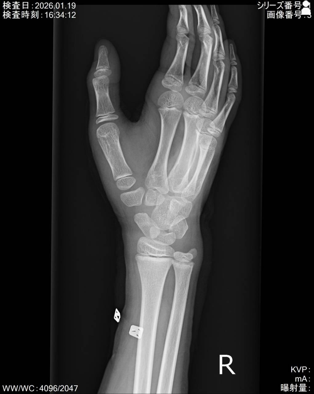 バスケットボールのプレー中に手を衝いて怪我した学生の初回対応と施術 大鳥居にある整骨院